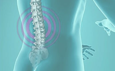Sciatica Sciatica